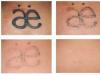Удаление татуировок - лазером и другими способами; выведение тату в домашних условиях